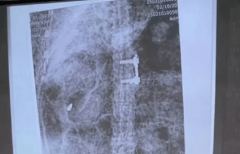 X-ray showing projectile in body